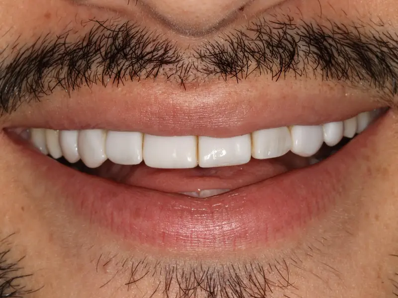 Antes das lentes de contato dental — dentes com desgaste e coloração alterada