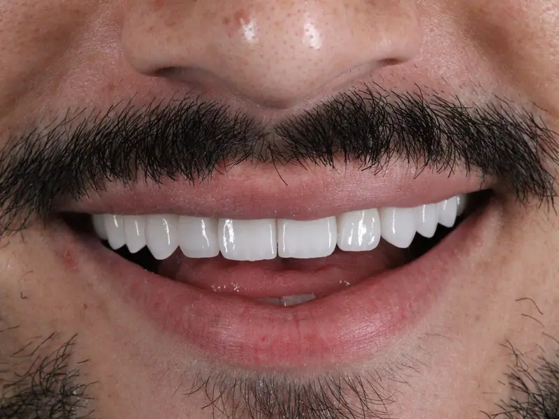 Depois das lentes de contato dental — sorriso branco, alinhado e natural