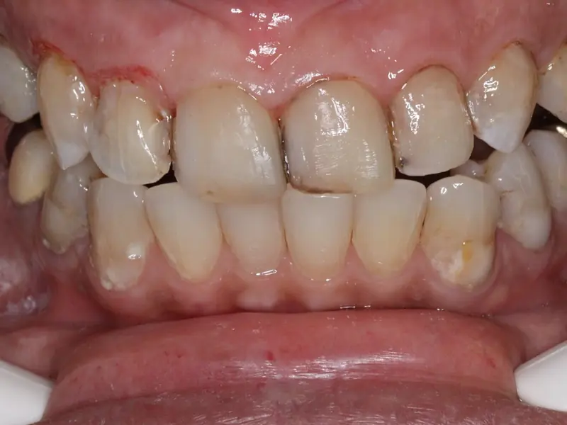 Antes da reabilitação oral — dentes desgastados e com coloração comprometida