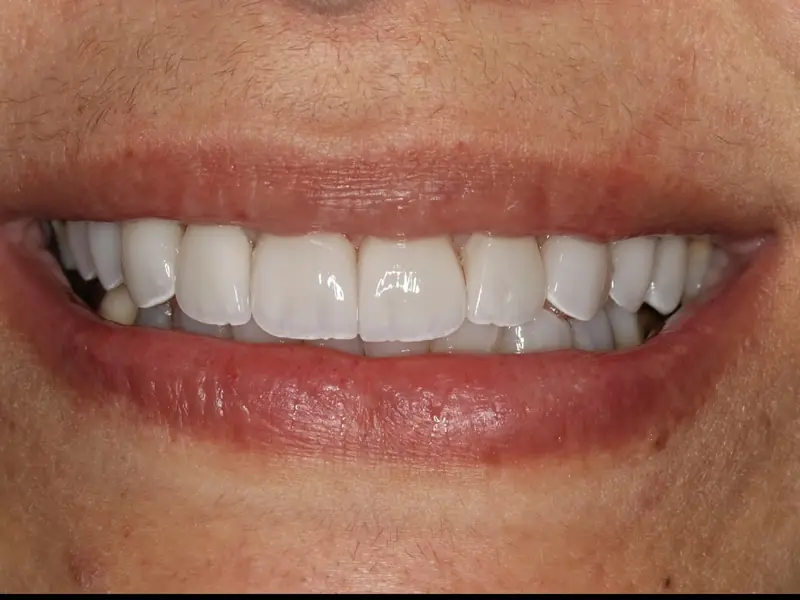 Depois da reabilitação oral — sorriso restaurado com harmonia e naturalidade