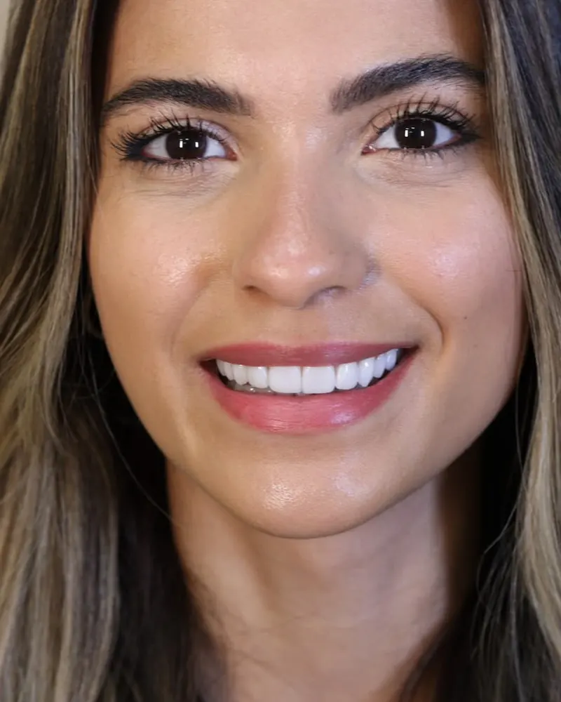 Close de sorriso com lentes de contato dental